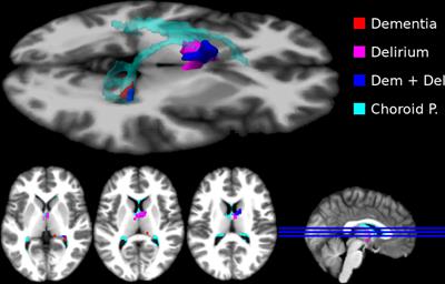 In vivo molecular imaging of the neuroinflammatory response to peripheral acute bacterial infection in older patients with cognitive dysfunction: A cross-sectional controlled study